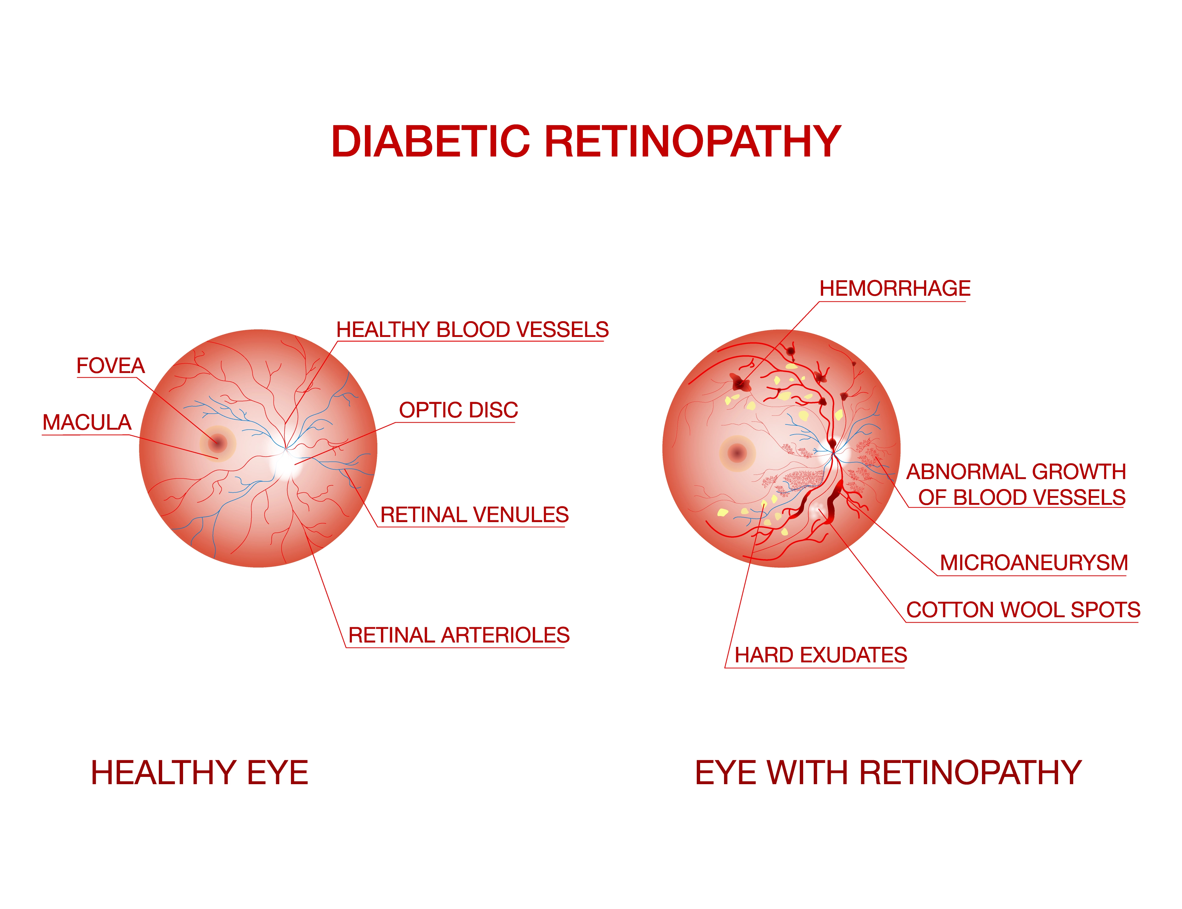 Early treatment of diabetic retinopathy at Eyeris Hospital